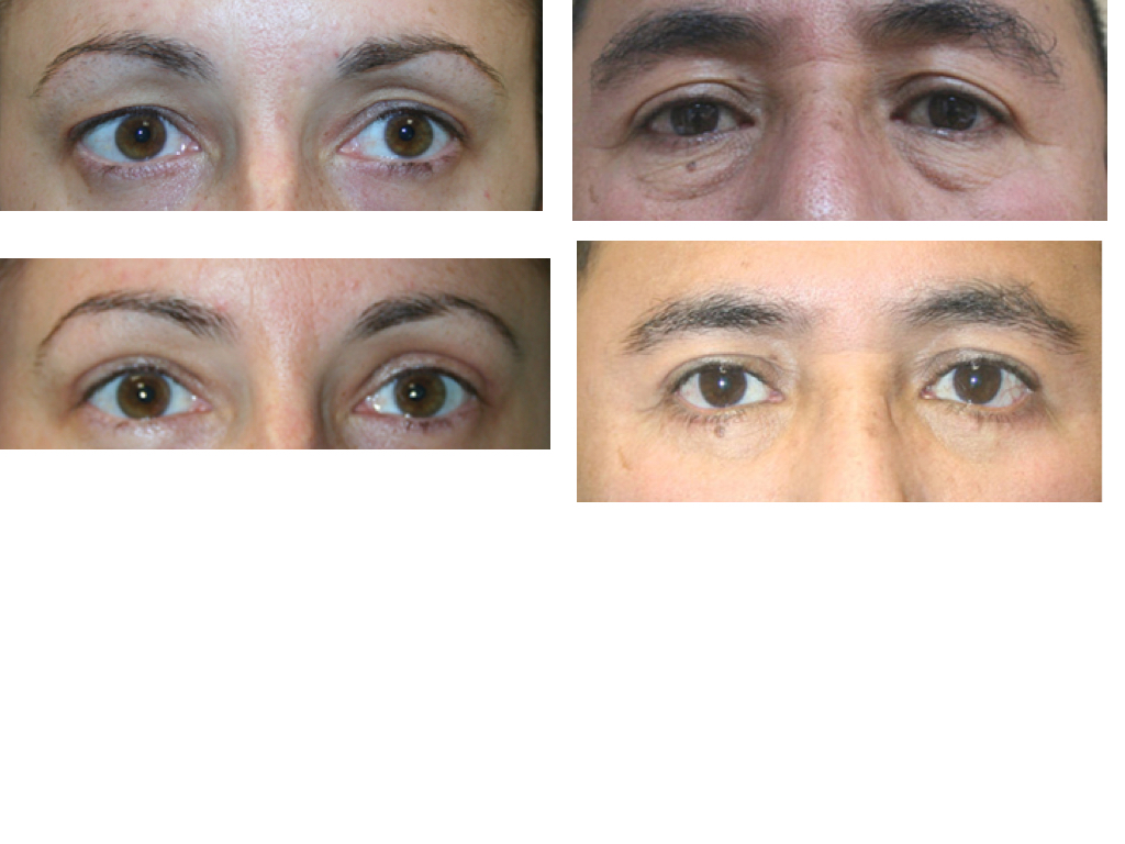 EYELID SURGERY